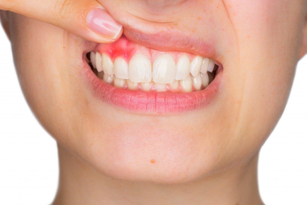 Closeup photo of woman smiling with teeth and damaged gums showing