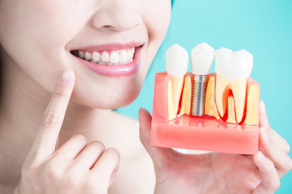 smiling woman holding a dental implant model